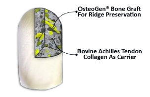OsteoGen Plugs